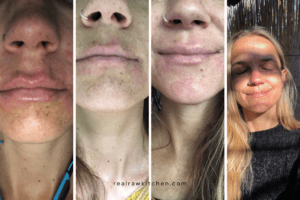 My Perioral Dermatitis Self-Care: Before & After